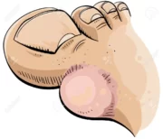 Blister on foot